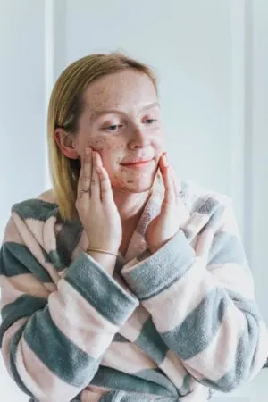 How to Get Rid of Acne [Alba Botanica&reg; Acnedote&trade; Review]